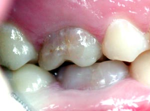Удлинение коронки зуба