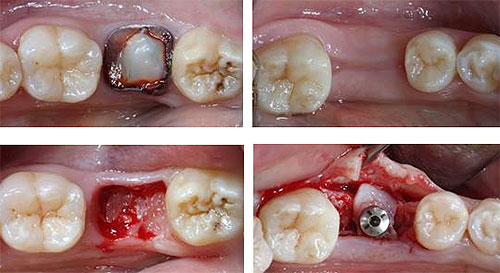 Хирургическая стоматология, удаление зубов, восстановление